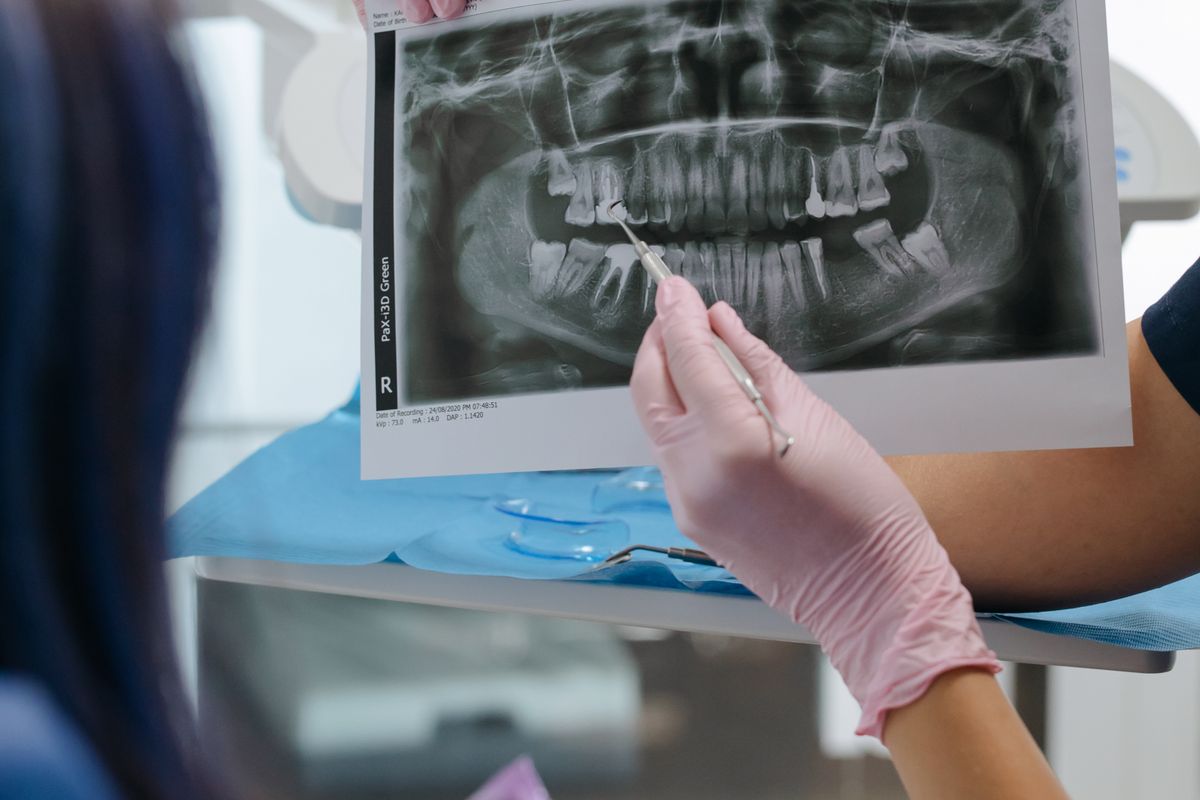 Follükuler Kist ile Ameloblastoma Ayrımı